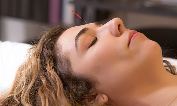 Acupuncture being used on woman in Austin for sleep support