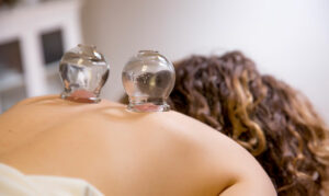 Woman treated for stress relief with cupping